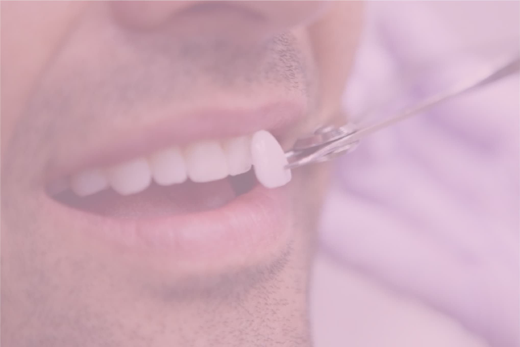 Trident Smiles Dental Veneers process stepbystep guide to the